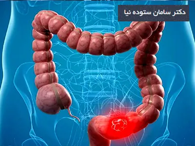 انواع بیماری‌های روده