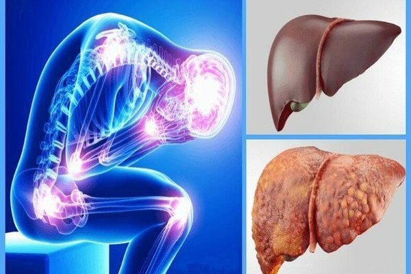 بیماری کبد چرب و علائم آن