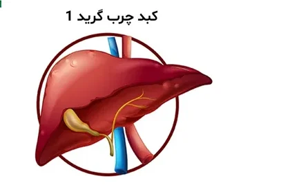 کبد چرب گرید 1 چیست؟