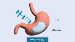 عوارض بوتاکس معده: هر آنچه باید بدانید قبل از اقدام