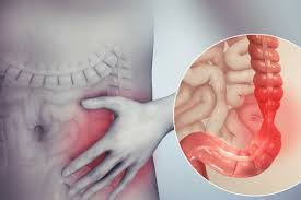 سندروم روده تحریک پذیر یا IBS چیست؟