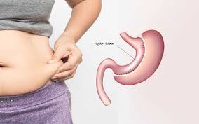 عمل اسلیو معده به روش لاپاراسکوپی